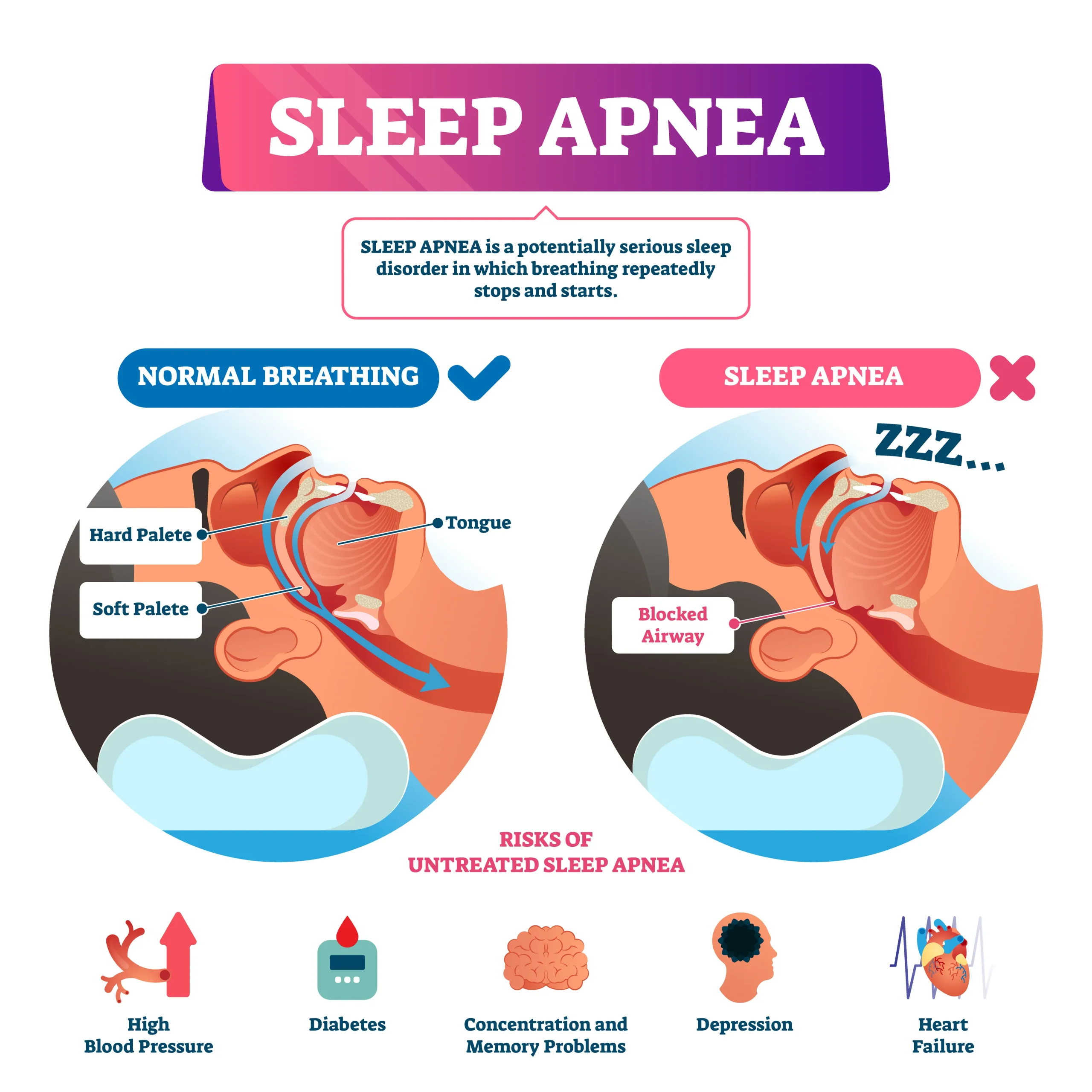 sleep apnea image